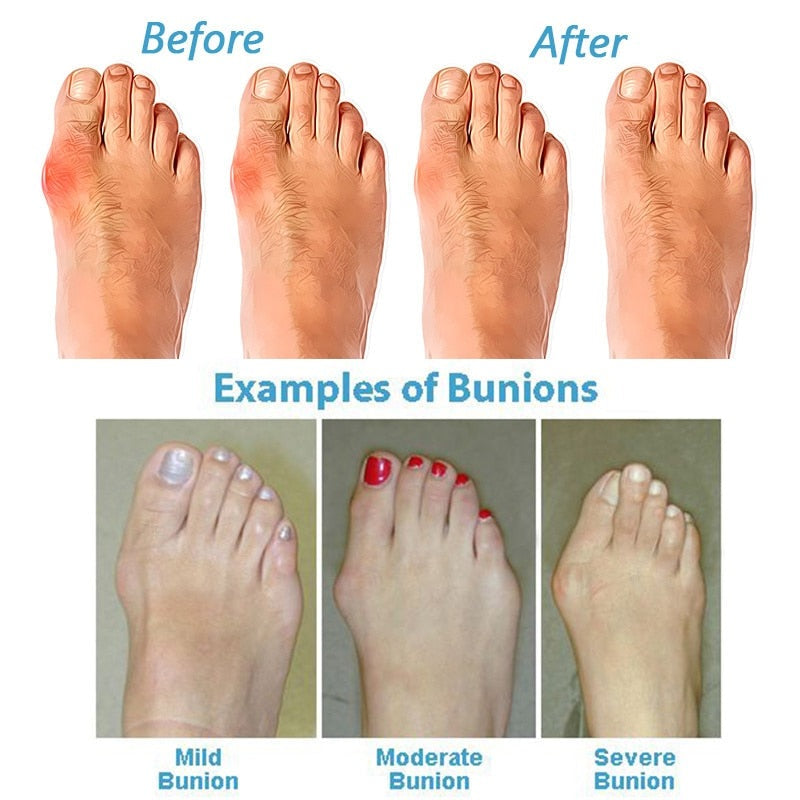 Orlando | Orthopedic Bunion Corrector Sandals